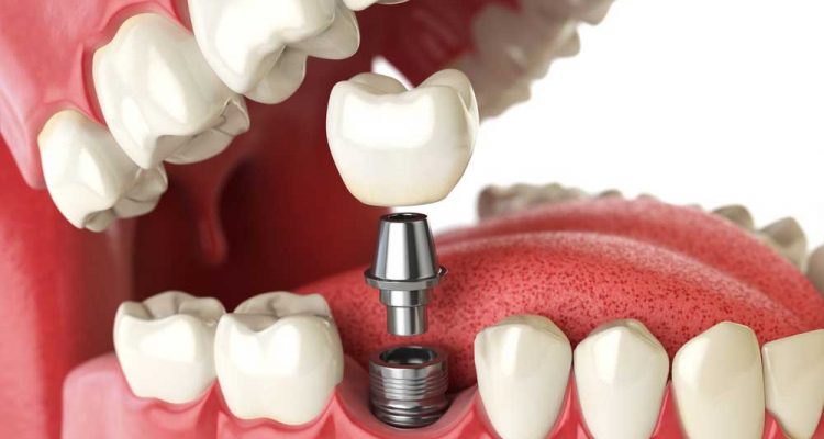 avantages-implant-dentaire